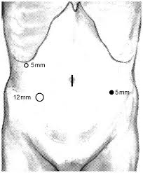 A loop of jejunum 15 to 20 cm from the ligament of treitz is brought up to the wound, and a circular pursestring suture is placed in the antimesenteric border. Laparoscopic Jejunostomy For Obstructing Upper Gastrointestinal Malignancies