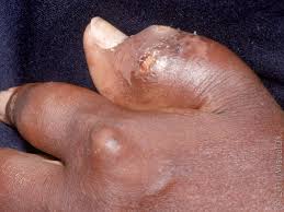Image result for gout