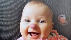 3 Orang Ini Miliki Tanda Lahir Paling Aneh di Dunia