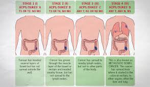Bowel Cancer Staging Size Position Spread