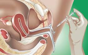 Artificial Insemination At Home Intrauterine Insemination Artificial Insemination Infertility