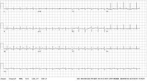 Myocarditis is a disease marked by the inflammation of the heart muscle known as the myocardium — the muscular layer of the heart wall. Ekg Shows Low Voltage Qrs Complexes Consistent With The Diagnosis Of Download Scientific Diagram