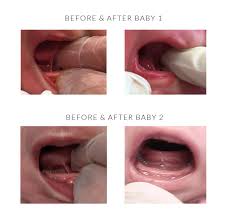 They attach the tongue to the bottom of the mouth at the front. Tongue Tie Faqs Buckinghamshire Chiltern Breastfeeding Partnership