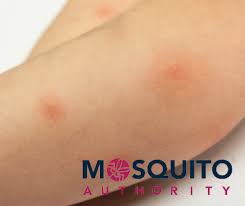 Image result for mosquito bite