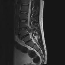 Maybe you would like to learn more about one of these? Cauda Equina Syndrome Radiology Case Radiopaedia Org
