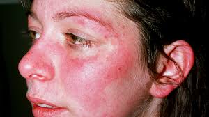 Lupus hastalığı bağışıklık sistemini, antijenler (belirli bir bağışıklık tepkisini indükleyebilen bir madde) ve sağlıklı doku arasında ayırt edemez hale getirir. Psoriasis Vs Lupus What S The Difference