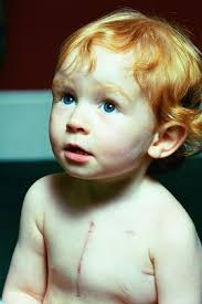 Scott Maciver Boy Worlds Smallest Pacemaker Editorial Stock Photo