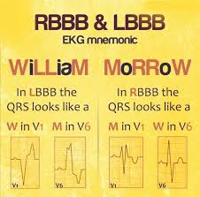Image result for Right Bundle Branch Block