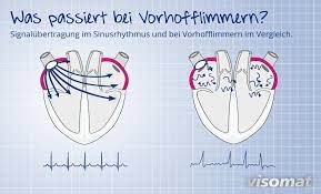 Vorhofflimmern Ursachen Und Behandlung Visomat Blutdruckmessgerate
