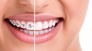The monthly payment amount will depend on the type of braces, the duration of treatment, and the duration of the payment plan. Cost Of Braces Treatment I M 23 Year Old Guy How Much Practo Consult