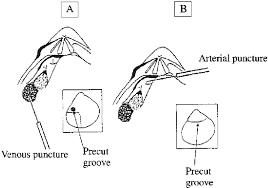 Image result for Venous Blood Sampling