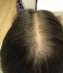 To add to the stress, there are a plethora of reasons why one may face hair thinning. Why Is My Hair Thinning Telogen Effluvium In Young Women Hair Loss Control Centre