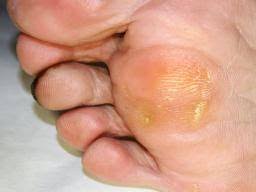 Ten Common Foot Problems Causes And Treatment