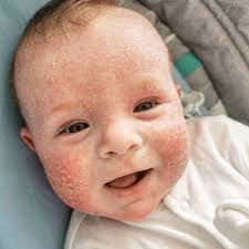 The caregiver should have no acute infection when doing mouth feeding. Baby Allergic To Milk Suffered Bleeding Blistered Skin And Produced Acid Water Mirror Online