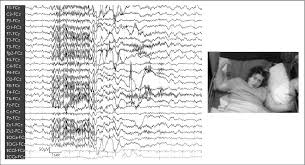 Wir twittern news, ahnungslos und nicht offiziell befugt, einschätzungen abzugeben. John Libbey Eurotext Epileptic Disorders Tonic Status Epilepticus In Patients With Idiopathic Generalized Epilepsy