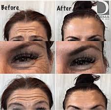 Botox To The Rescue Botox Botox Injections Dysport