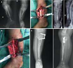 Image result for Osteomyelitis