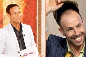 Gone Today Hair Tomorrow The Bald Truth Behind Celebrity Hair Transplants Hair Transplant Hair Loss Men Hair Loss Bald