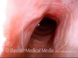 Image result for Croup