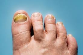 Image result for Onycholysis feet
