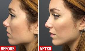 Would You Have A Non Surgical Nose Job Nonsurgical Nose Job Nose Surgery Nose Job