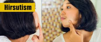 Today, boldsky will share with you some causes of excessive facial hair growth in women. Hirsutism Causes Symptoms Diagnosis Treatment And Prevention