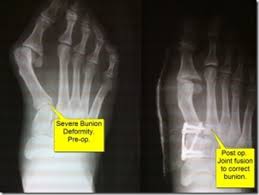 Be sure to perform any rehab exercises they recommend during your recovery period. Bunion Surgery Before And After Pictures Best Podiatrist Nyc