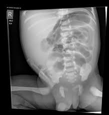 Image result for Intestinal Atresia