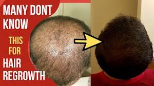Some examples are as follows: Hair Regrowth Remedies 2021 Part 2 Baldness Hair Growth Hair Loss Cure Herbal Hair Growth Youtube