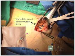 The initial treatment for a pulled groin injury depends on the severity but in general stop activity and ice for 20 minutes and wrap with an ace bandage. Hernia Types Sports California Hernia Specialists