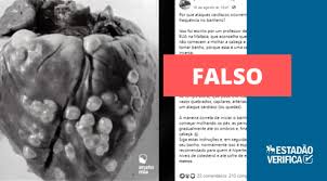 Um enfarte agudo do miocárdio (português europeu) ou infarto agudo do miocárdio (português brasileiro). E Falso Que Molhar A Cabeca Primeiro No Banho Aumente O Risco De Ataque Cardiaco