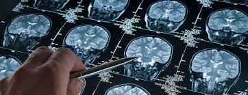 Cryptococcus is the most common fungal disease to affect the brain of cats and it often causes a generalized encephalomyelomeningitis. Skull Base Tumors Johns Hopkins Medicine