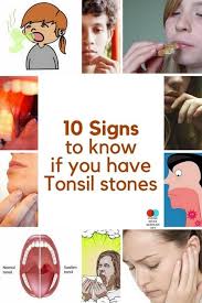 Check out these tonsil stones photos. Pin On Things To Wear