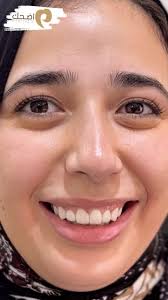 اقل برد للأسنان بأفضل نتيجه لضحكه جديده ❤️, د.ندى بدر الدين , #dentist  #viral #design #dentist #dentaltechnician #dentallaboratory #video #viral  #fypシ #fyp #reels #reelsinstagram #cairo #egypt ...