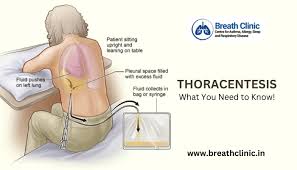Image result for Thoracentesis