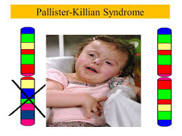 The extra genetic material from isochromosome 12p disrupts the normal course of development, causing the characteristic features of this disorder. Chromosomal Abnormalities I Sdk October 21 Ppt Video Online Download