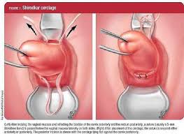It feels like a round donut or ball high inside your. Cervix And Early Pregnancy