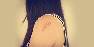 This treatment involves surgically cutting out the keloid. Keloid Scars On Skin Meaning Treatment And Cost