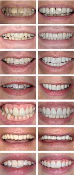 How to fix crooked bottom teeth without braces. New Crooked Teeth Solutions And Treatments The Perfect Smile