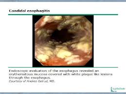 It connects the pharynx to the stomach; Esophagitis