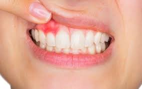 Image result for Gingivitis