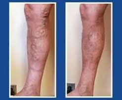 Tuhá, matný povrch, pevně lne ke stěnám cévy). Kako Nastaju Krvni Ugrusci I Kako Se Lijeci Tromboza Ordinacija Hr