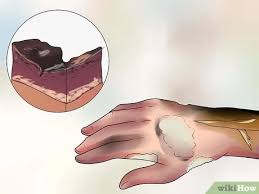 We did not find results for: How To Treat A Hot Water Spill On Your Skin 14 Steps