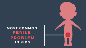 Management of balanitis and balanoposthitis in children and adolescents, normal development of the uncircumcised penis, and balanitis in adults are discussed separately. Common Penile Problems In Boys Children S Health Healthcare Knowmadic Youtube