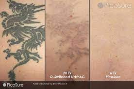 Laser tattoo removal in wilmington on yp.com. Laser Tattoo Removal Before After Photos Winston Salem Nc