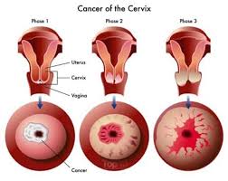 If the cancer has spread to your nearby organs, it can affect how those organs work too. 10 Important Warning Signs Of Cervical Cancer That You Should Not Ignore Elite Readers