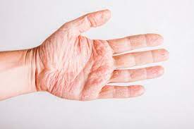 Neurodermitis Ursachen Symptome Und Therapie Rundumgesund De