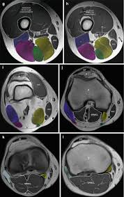 Anatomy arthrogram anatomy basic shoulder mri. Posterior Compartment Of The Thigh Muscles Injuries Musculoskeletal Key