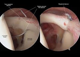 Shoulder diagram to mainly explain you about how your shoulder work and to describe every inner part of your shoulder including muscles, joints, and every human has a body part called shoulder. My Shoulder Superior Labrum Is Torn Do I Need Surgery Shoulder Elbow