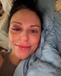 RIP my black eye, 4/22-5/10/2025